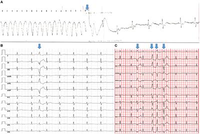 Case report: Multiple biventricular aneurysms in arrhythmogenic cardiomyopathy